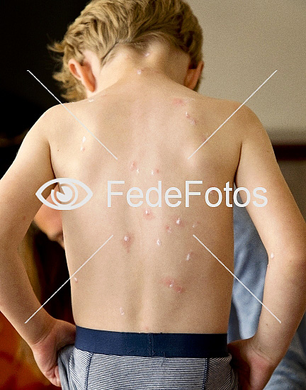 Dreng på tre år med skoldkopper